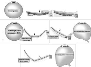 Паркетное глазное дно при миопии